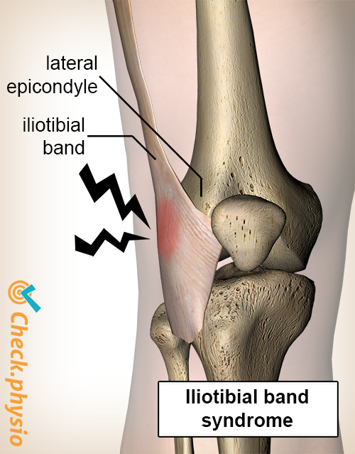 Iliotibial band syndrome