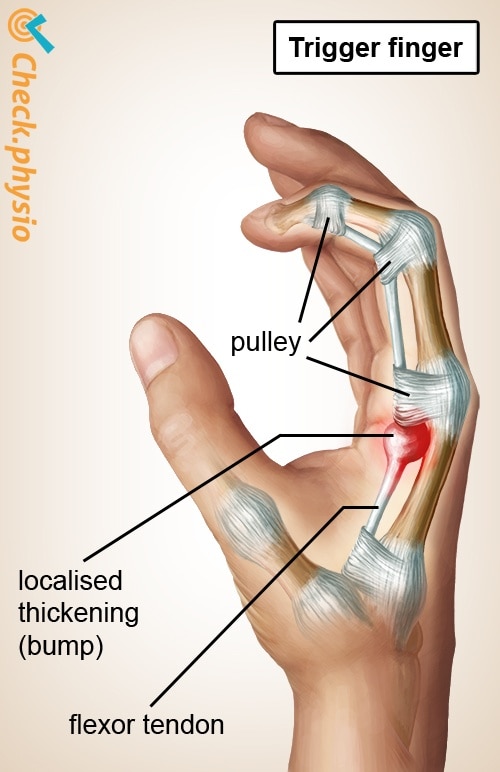 Muscle injury of the upper back