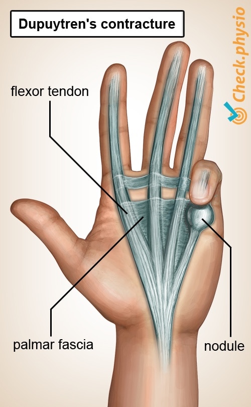 dupuytren s contracture causes)