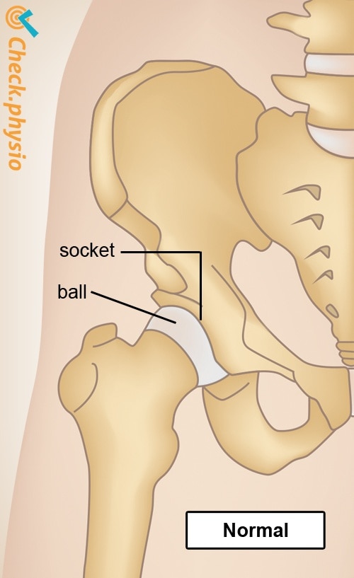 hip osteoarthritis healthy