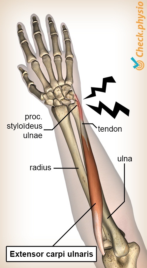 arm forearm extensor carpi ulnaris tendinitis tendinopathy