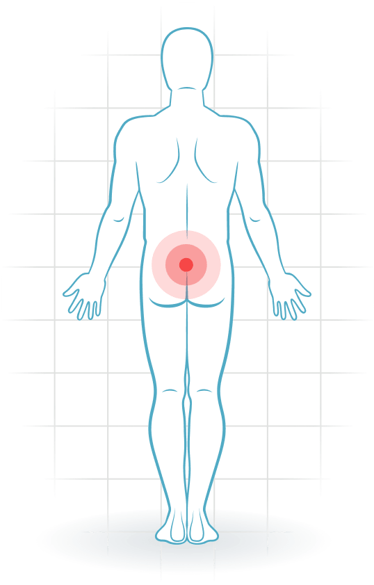 pijnlocatie Lumbar facet syndrome