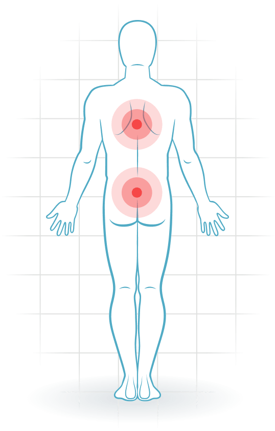 pijnlocatie Bechterew's disease