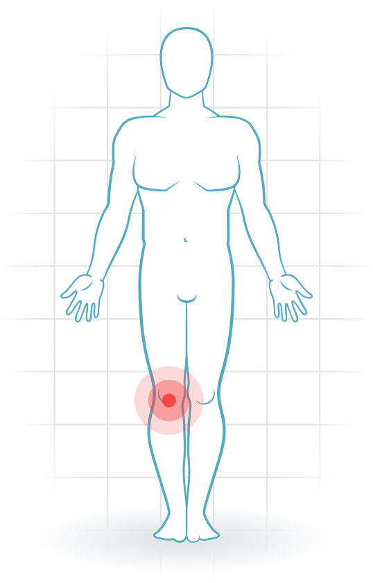 pijnlocatie Degenerative meniscus injury