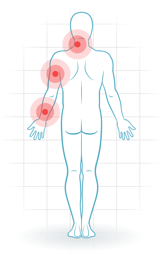 pijnlocatie CANS (complaints of arm, neck and/or shoulder)