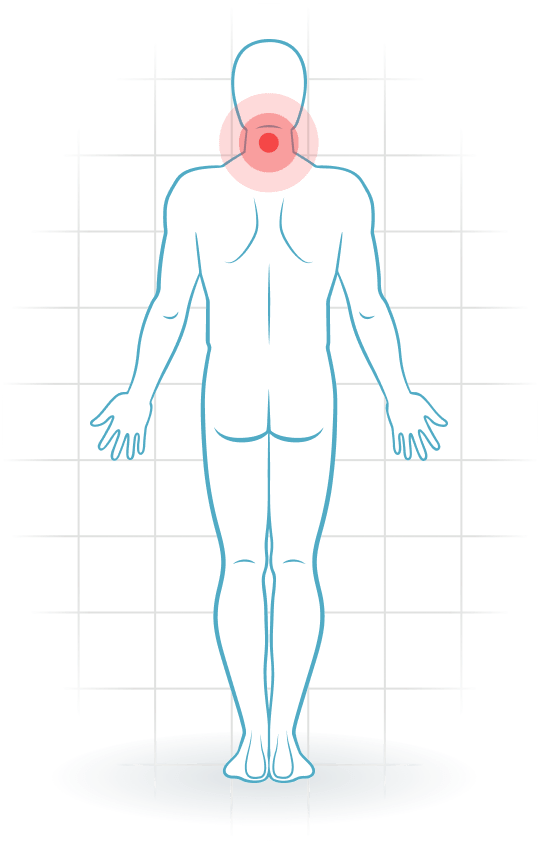 pijnlocatie Whiplash associated disorders