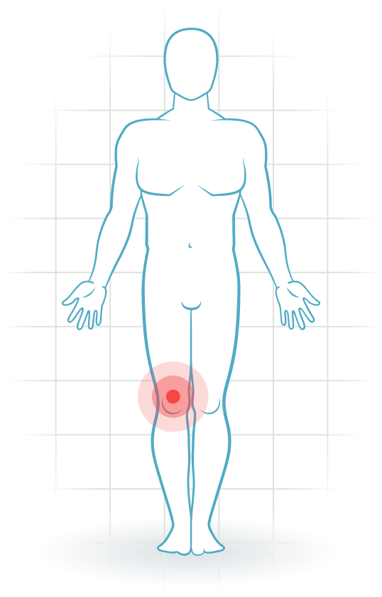 pijnlocatie Quadriceps tendinitis