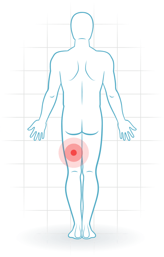 pijnlocatie Hamstring injury