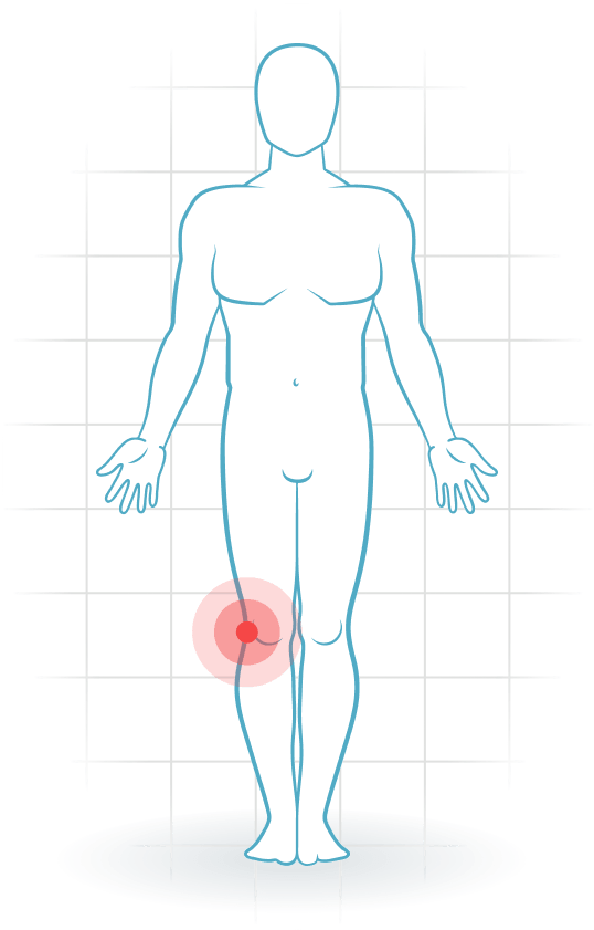 pijnlocatie Iliotibial band syndrome