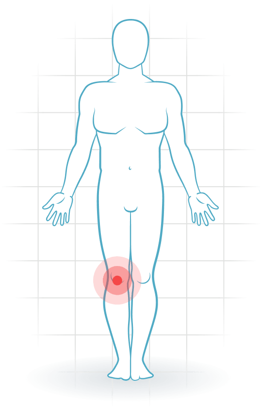 pijnlocatie Osteoarthrosis of the knee