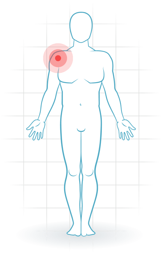 pijnlocatie Osteoarthrosis of the shoulder