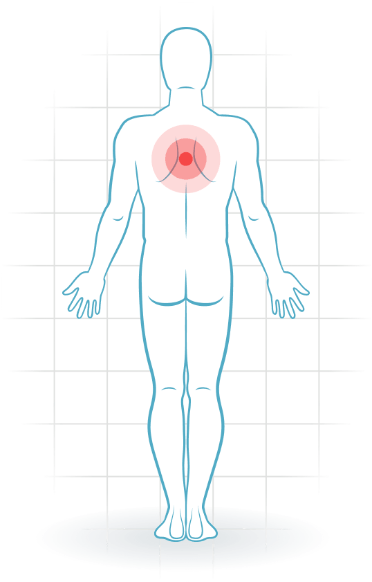 pijnlocatie Muscle injury of the upper back