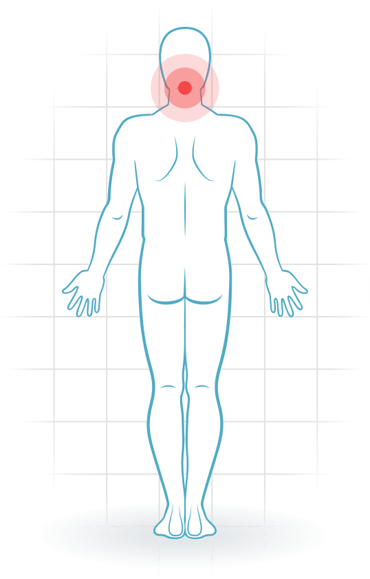 pijnlocatie Cervical facet syndrome