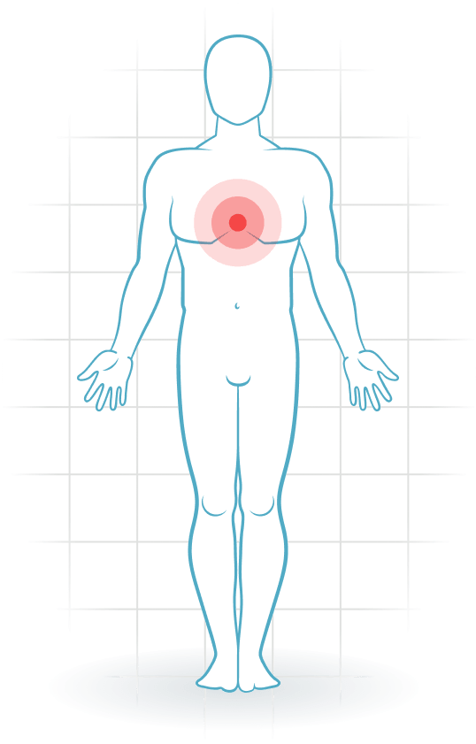 pijnlocatie Tietze's syndrome