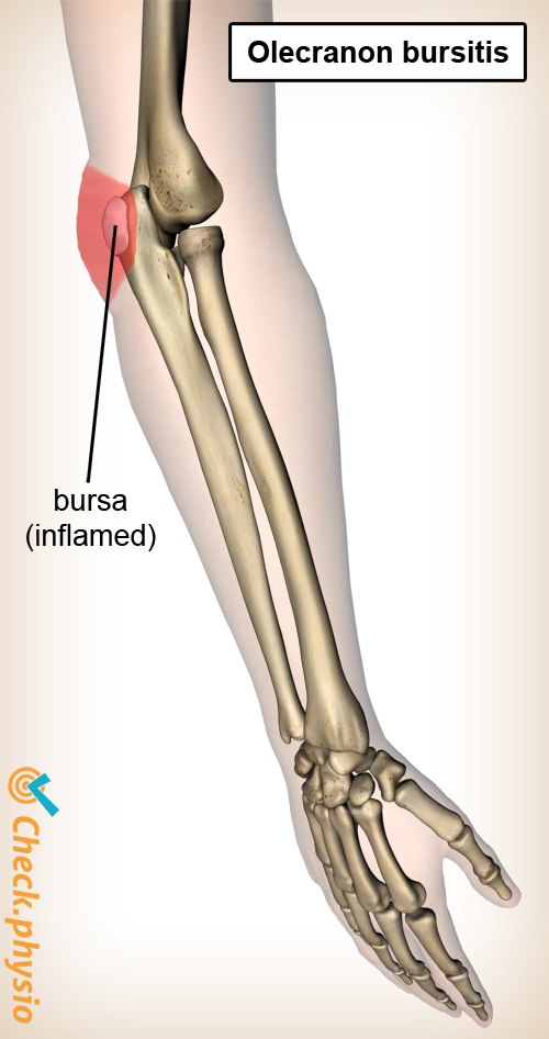 arm olecranon bursitis anatomy