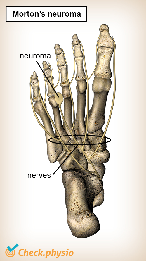 foot mortons neuroma