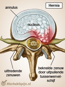 spinal column spine vertebra intervertebral disc hernia nerves