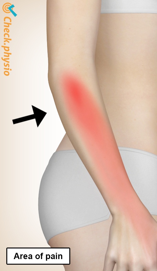 radial tunnel syndrome home treatment