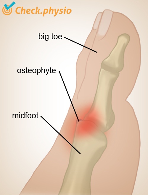 foot hallux rigidus osteophyte toe