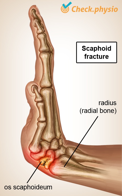os scaphoideum fracture)