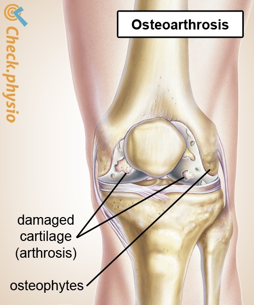 knee osteoarthrosis damaged cartilage arthrosis