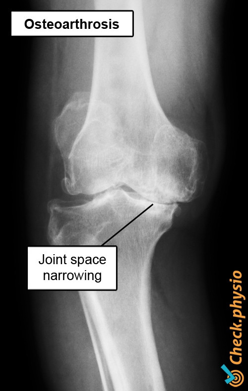 knee osteoarthrosis gonarthrosis joint space narrowing x ray
