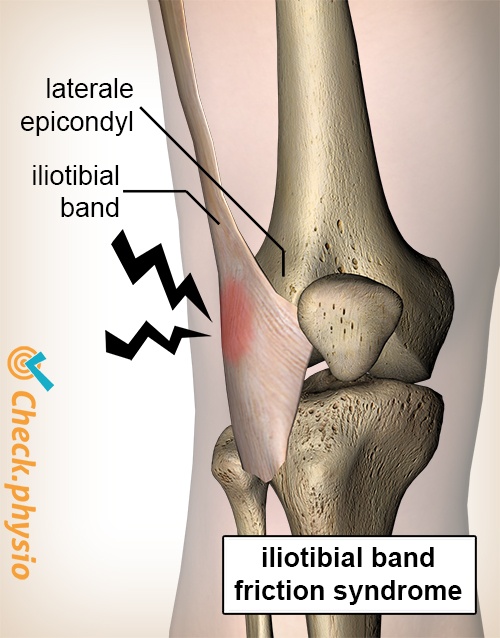 knee tractus iliotibialis friction syndrome lateral epicondyle