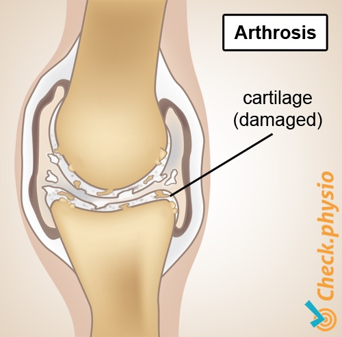 Knee Anatomy Cartilage Damage Gallery - How To Guide And 