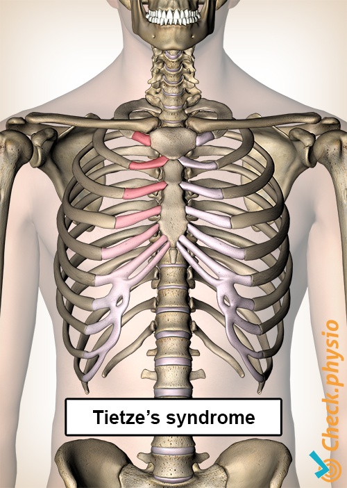 tietze tietzes syndrome ribs pain chest sternum