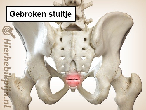 Gebroken stuitje coccygis fractuur staartbeen breuk