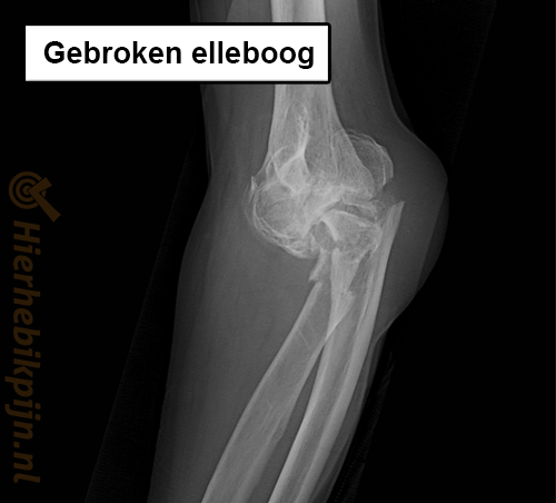 Rontgenfoto gebroken elleboog fractuur